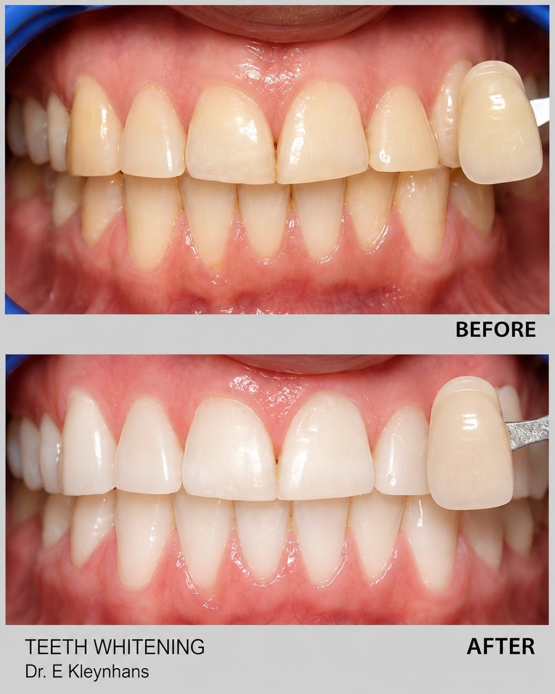 Before and after teeth whitening result at Smile Connection Dental Studio, Newlands, Pretoria